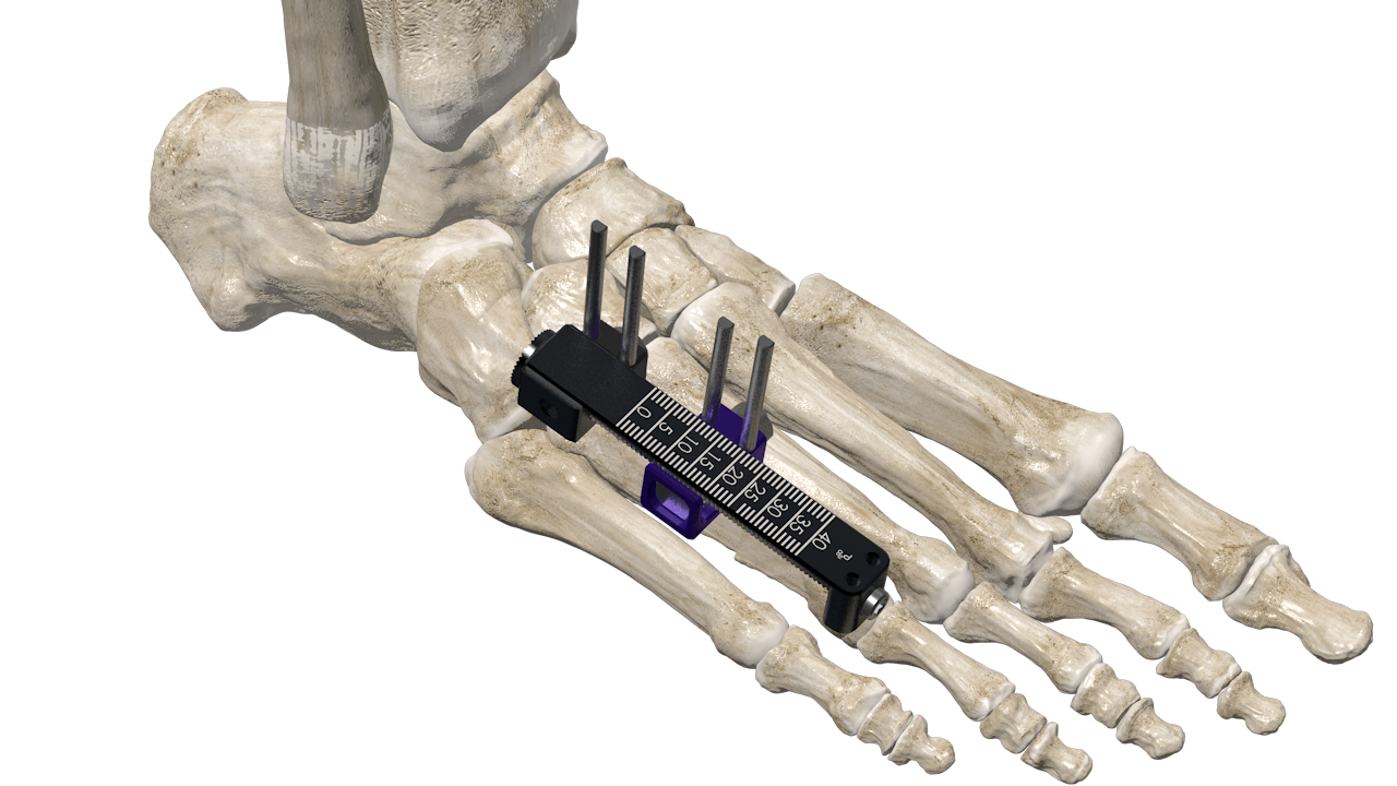 Brachiator™ mini rail applied to a foot model